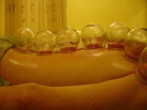 Cupping in traditional Chinese medicine