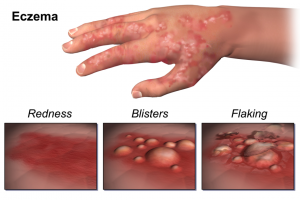 Eczema-Ferlow-gesund